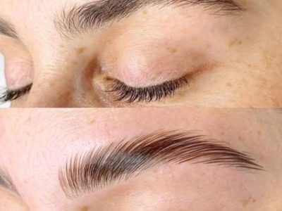 Browlift